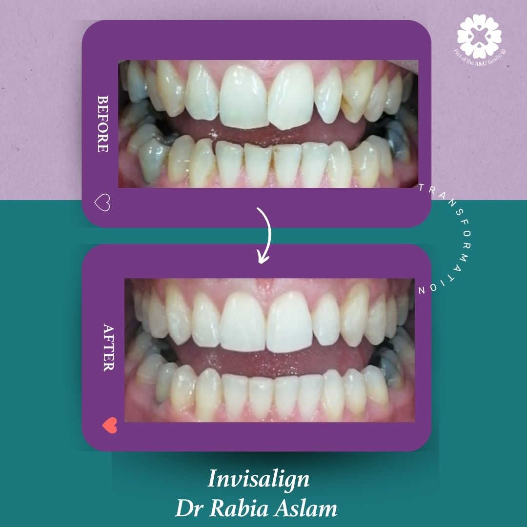 ADC - Dr Rabia - Before and After (3)