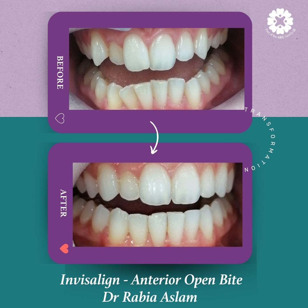 ADC - Dr Rabia - Before and After (4)