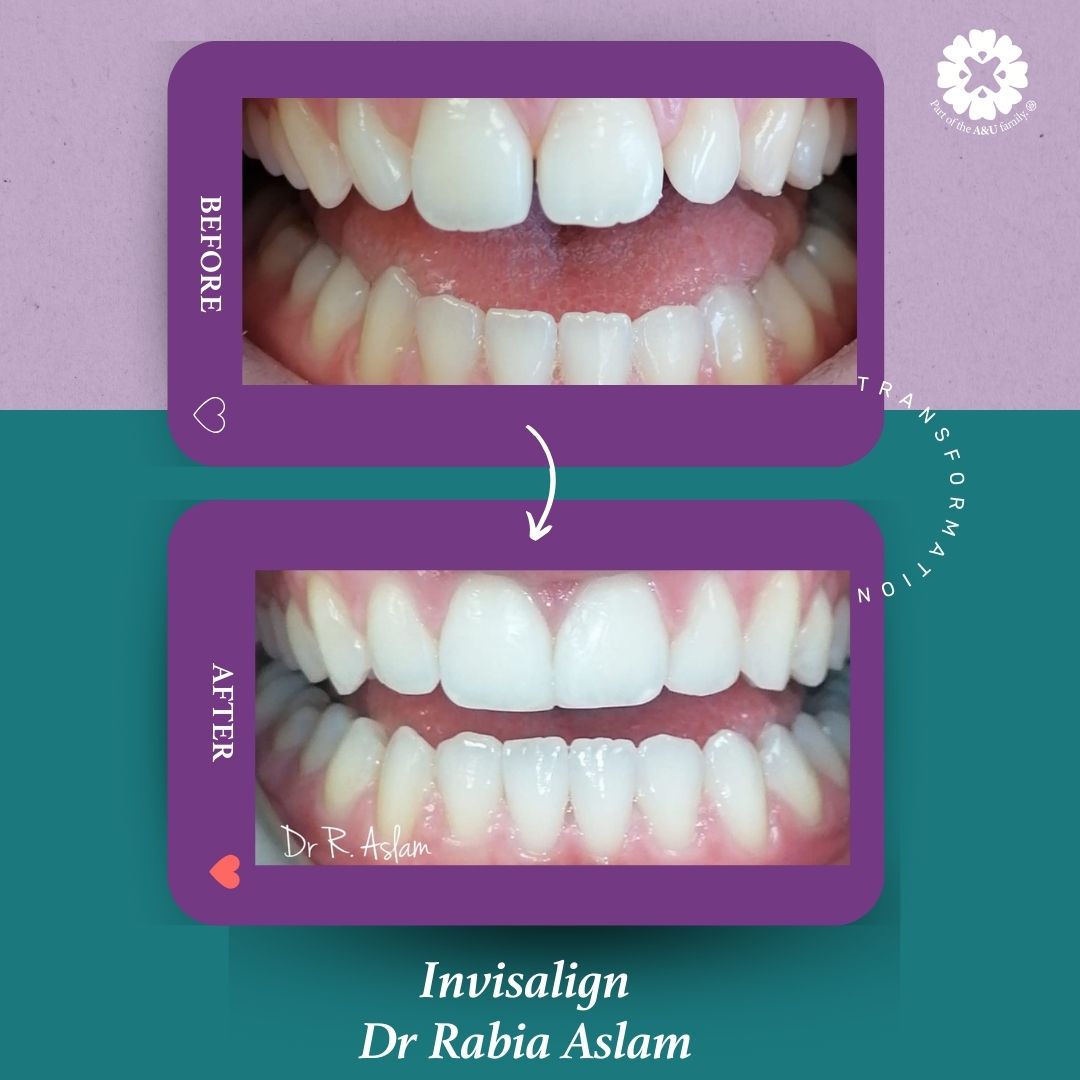 ADC - Dr Rabia - Before and After (5)