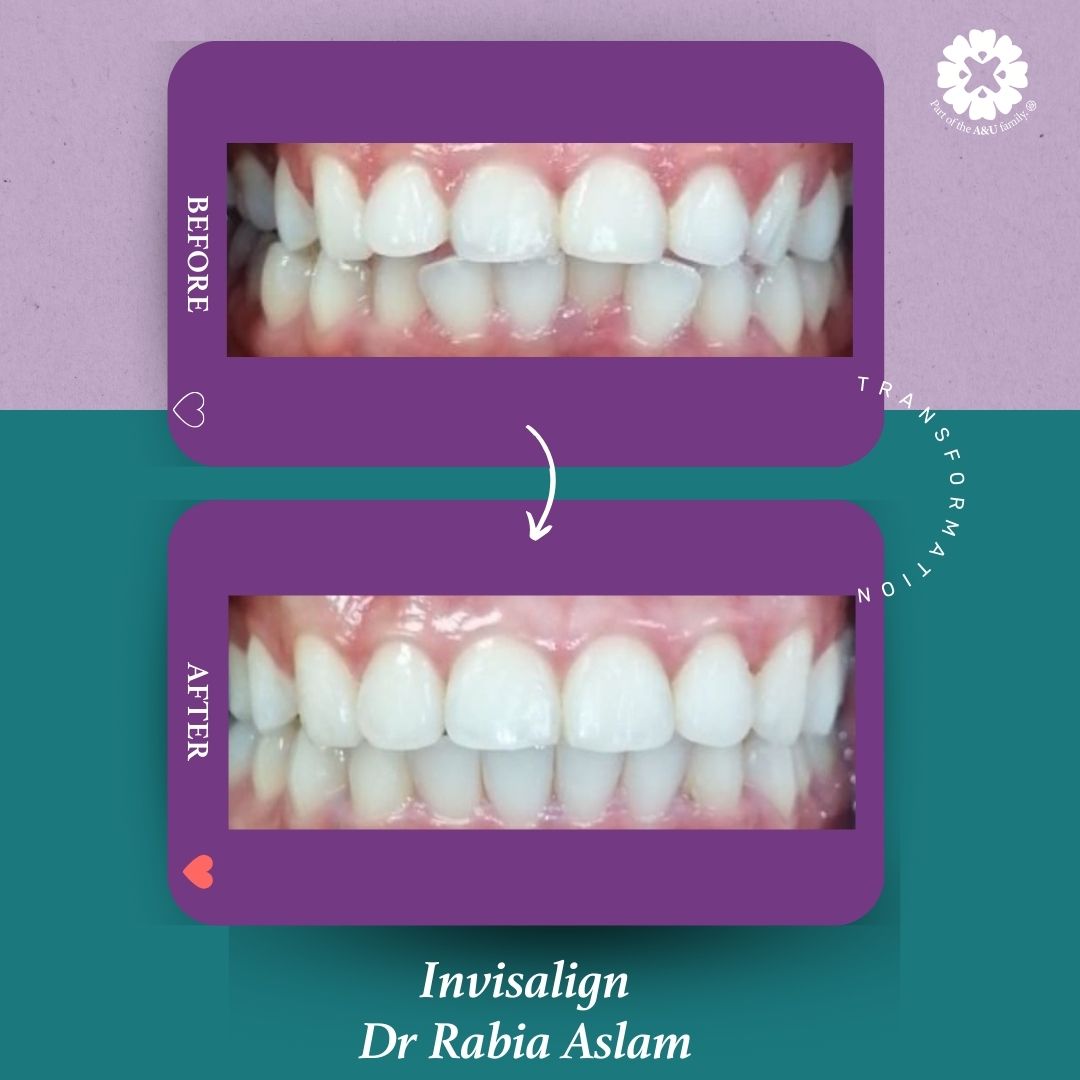 ADC - Dr Rabia - Before and After (6)