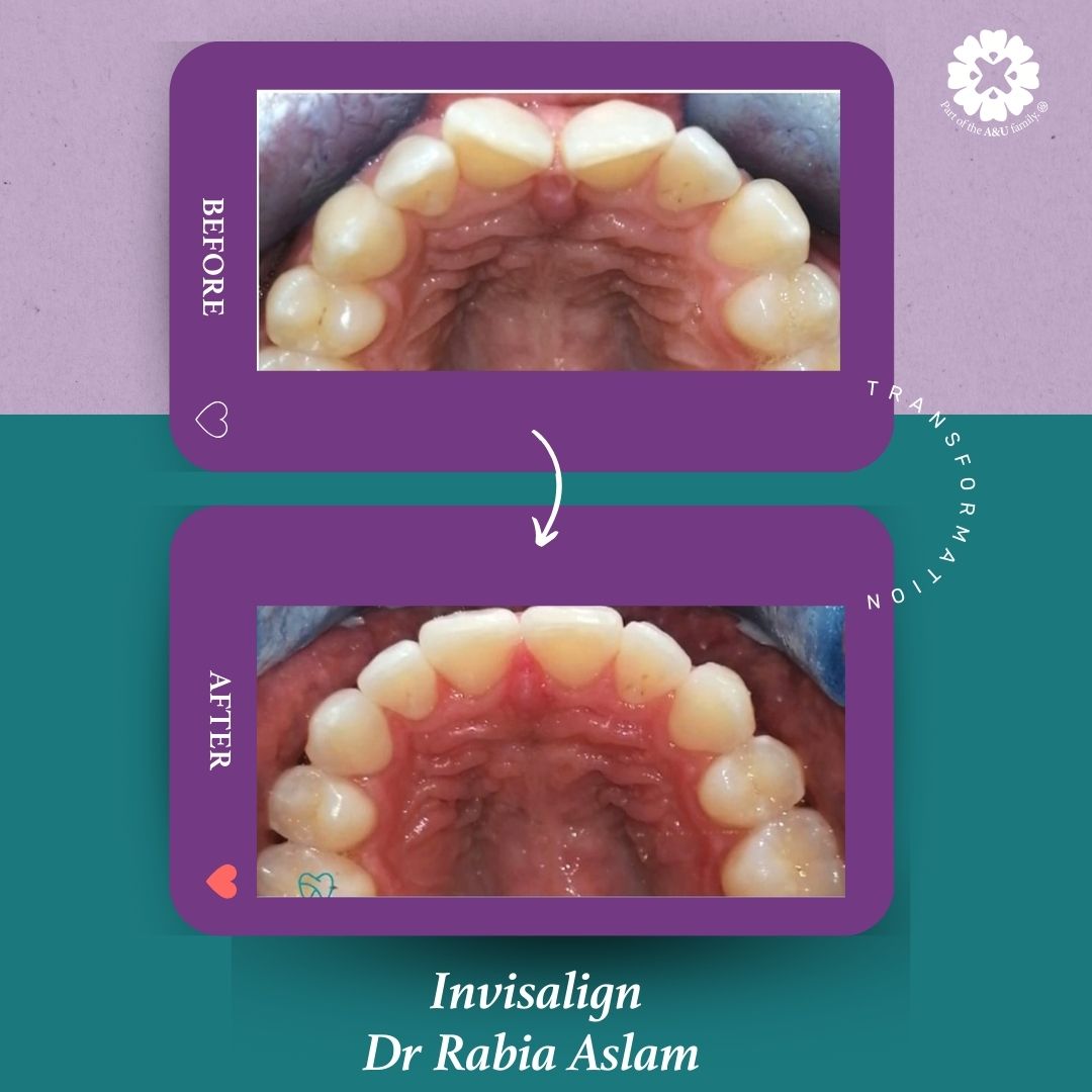 ADC - Dr Rabia - Before and After (7)