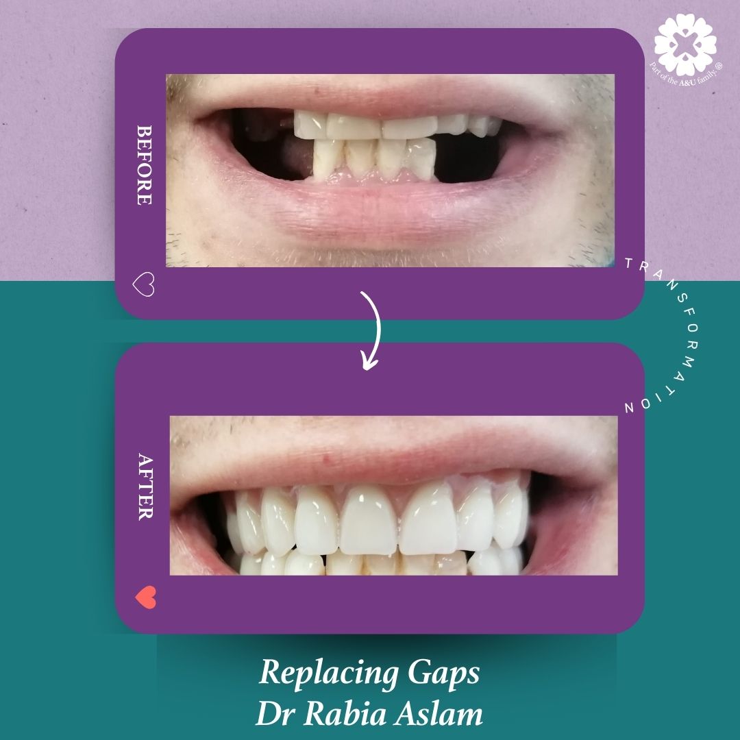 ADC - Dr Rabia - Before and After (9)